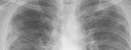 明解 画像診断の手引き：呼吸器領域編Supplシリーズ